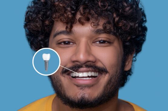 young man with toothy smile demonstrating his dental implant copy